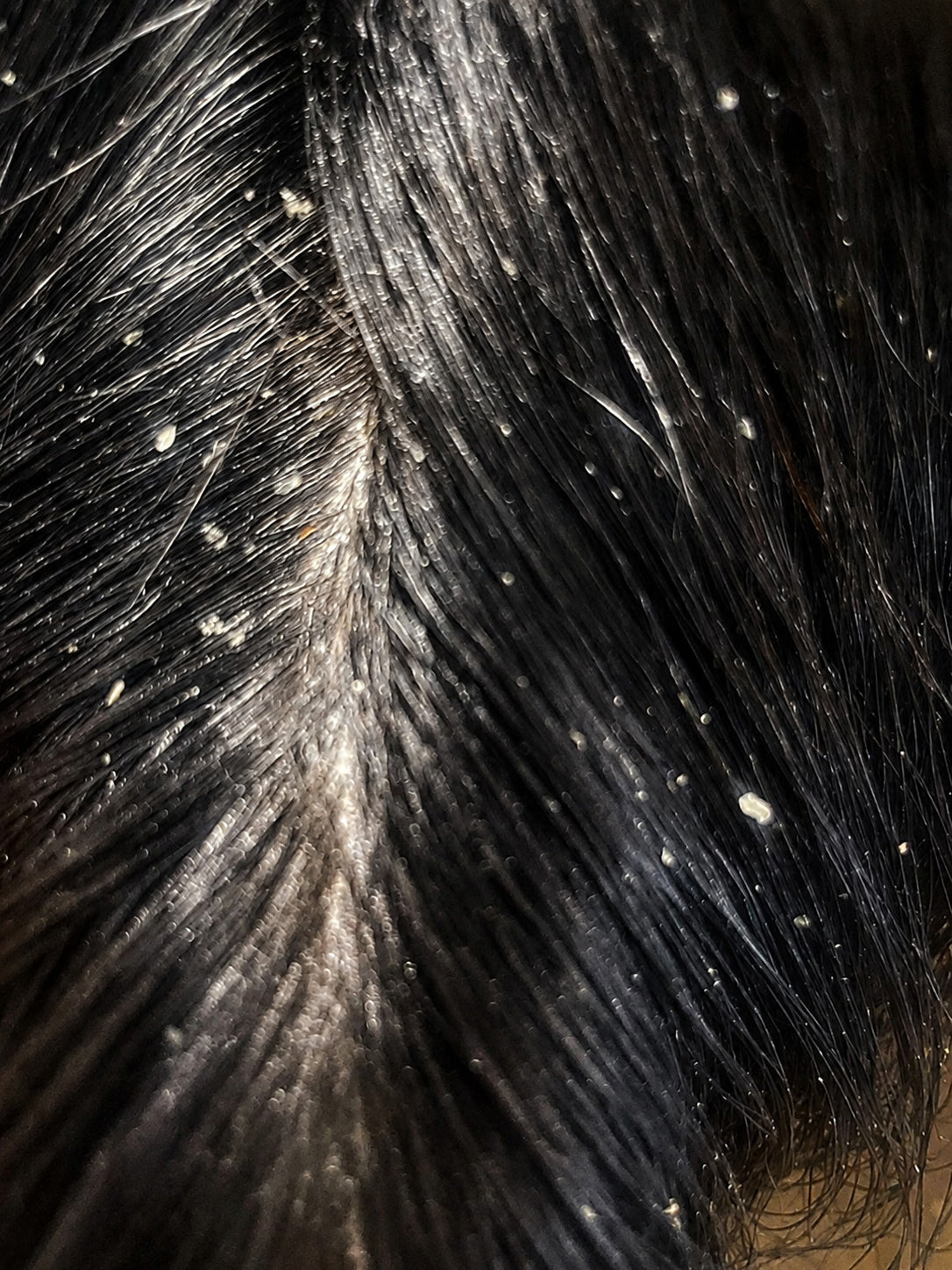 When Dandruff Isn’t Just Dry Skin